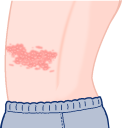 水疱瘡